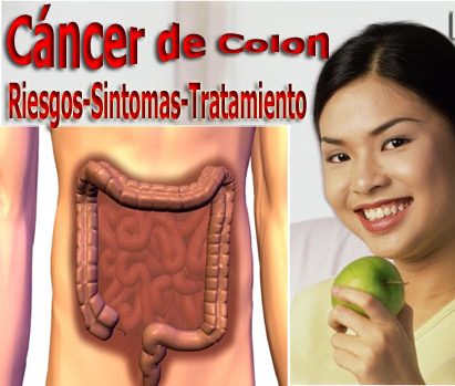 los síntomas de cáncer de colon