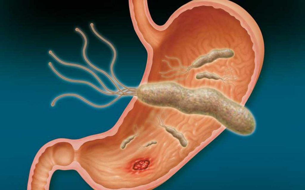 sintomas de la gastritis causada por helicobacter pylori