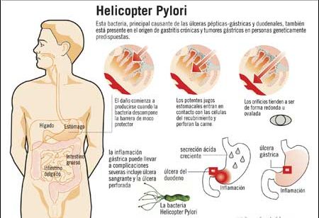 causas y sintomas de helicobacter pylori