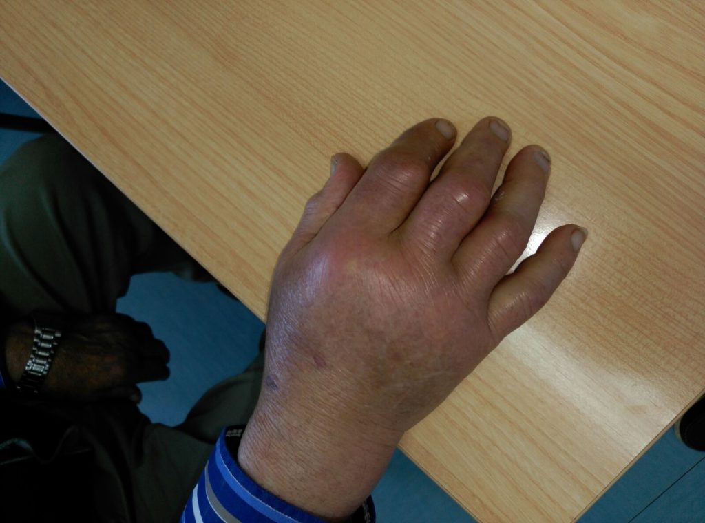 Symptoms of Gout