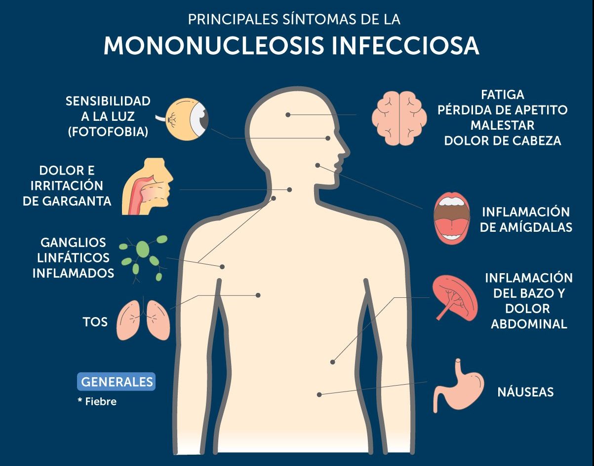 Monkeynucleosis в™ҐИнфекционный мононуклеоз. Симптомы. Диагностика