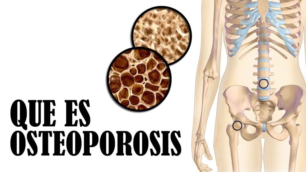  sintomas del a osteoporosis