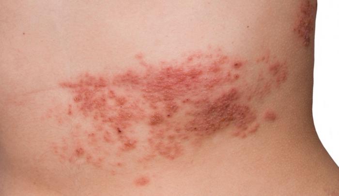 sintomas de herpes zoster en adultos