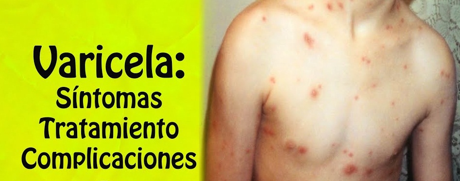 sintomas de la varicela antes del brote