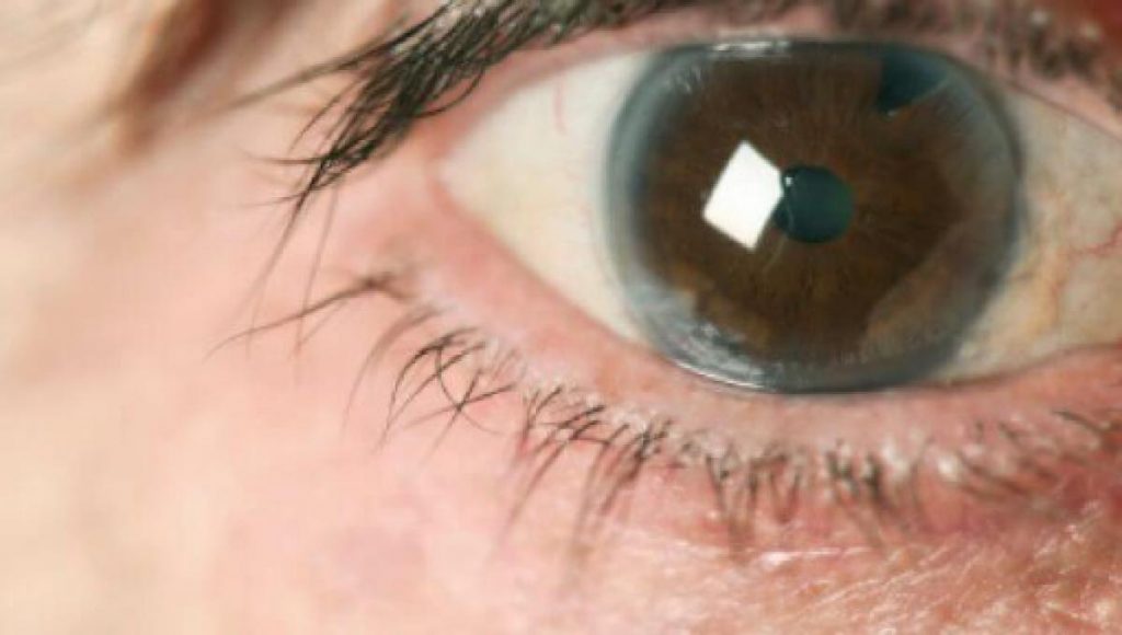glaucoma avançado sintomas