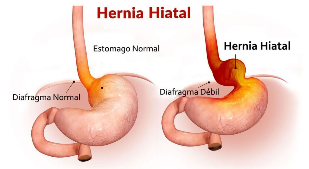hernia de hiato inflamada sintomas