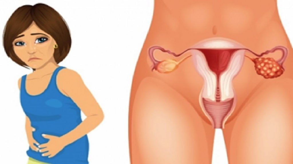 cancer de ovarios sintomas iniciales
